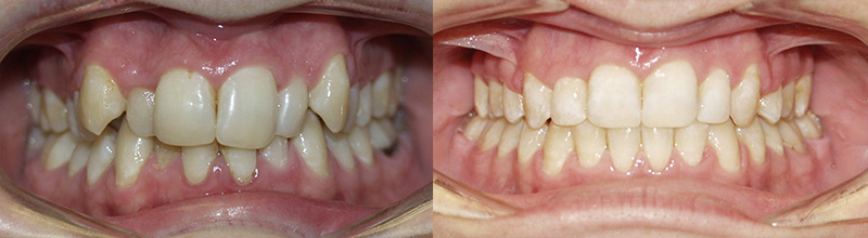 before after