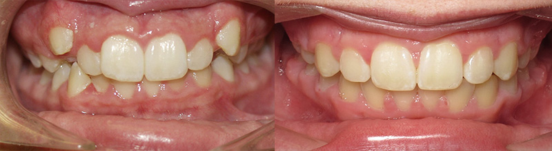 before after