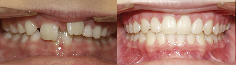 before after